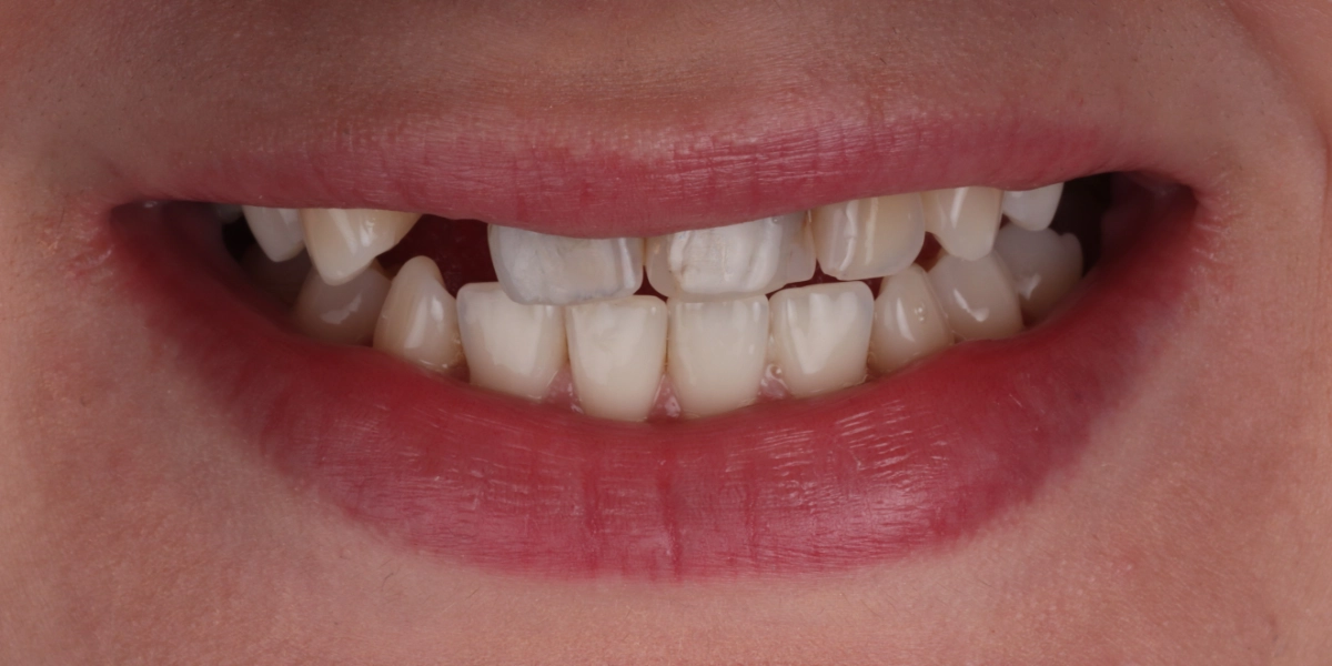 implantate-vorher implantate-vorher