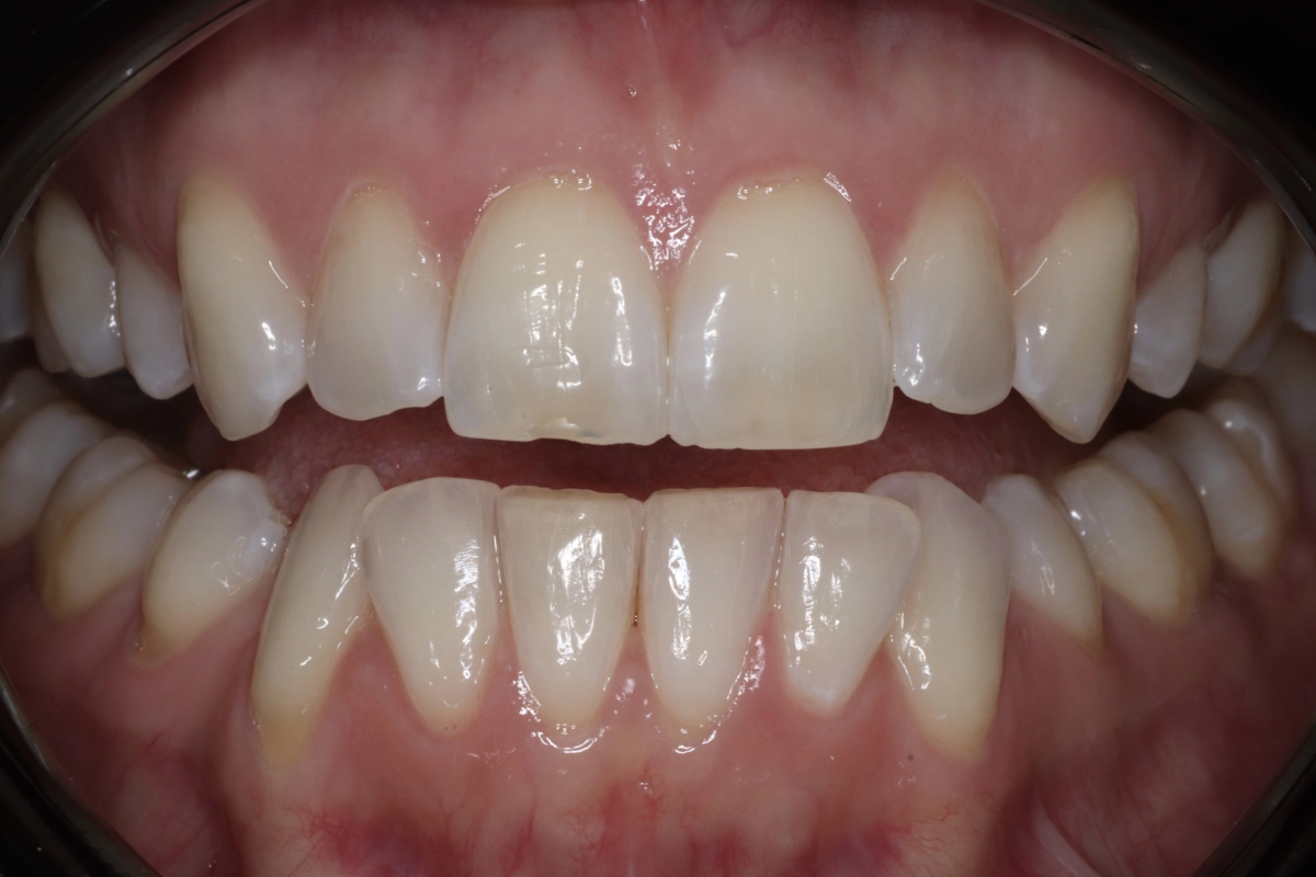 bleaching-krefeld-vorher bleaching-krefeld-vorher