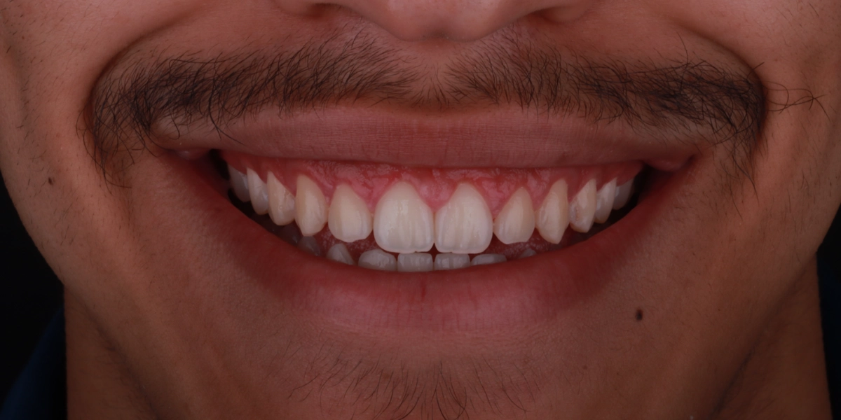 gummy-smile-gingivektomie-nachher