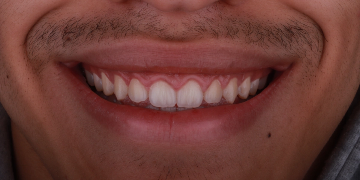 gummy-smile-gingivektomie-vorher gummy-smile-gingivektomie-vorher