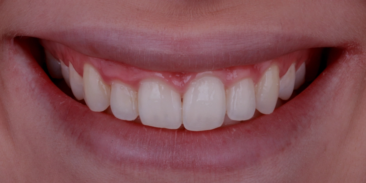 gummy-smile-krefeld-vorher gummy-smile-krefeld-vorher