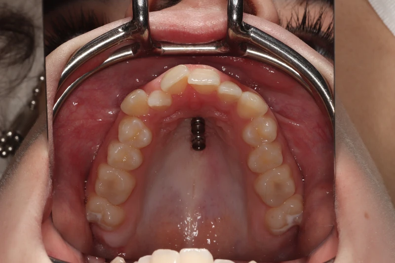 mini implantat