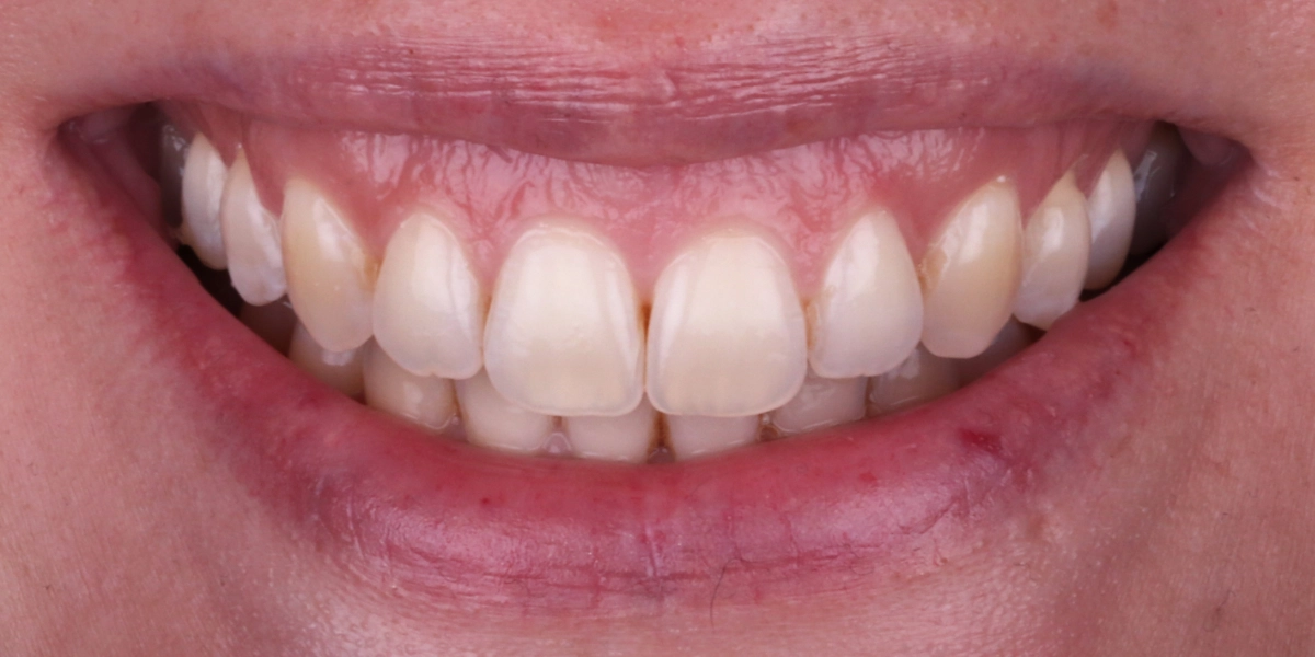 gummy-smile-lip-respositioning-nachher-2