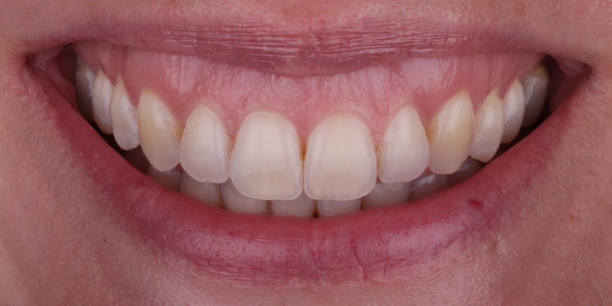 gummy-smile-lip-respositioning-vorher-2 gummy-smile-lip-respositioning-vorher-2