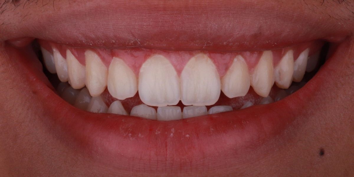 gummy-smile-nachher-2
