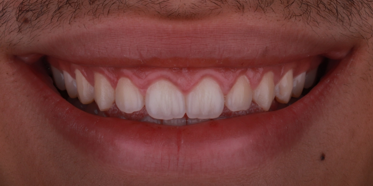 gummy-smile-vorher-2 gummy-smile-vorher-2