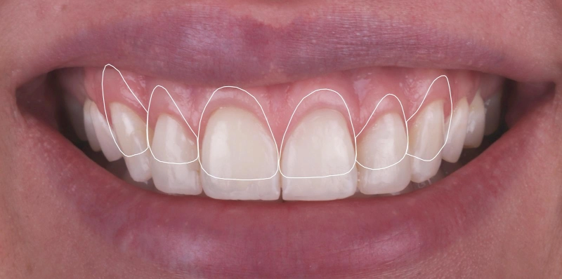 gummy smile zahnarzt krefeld doku