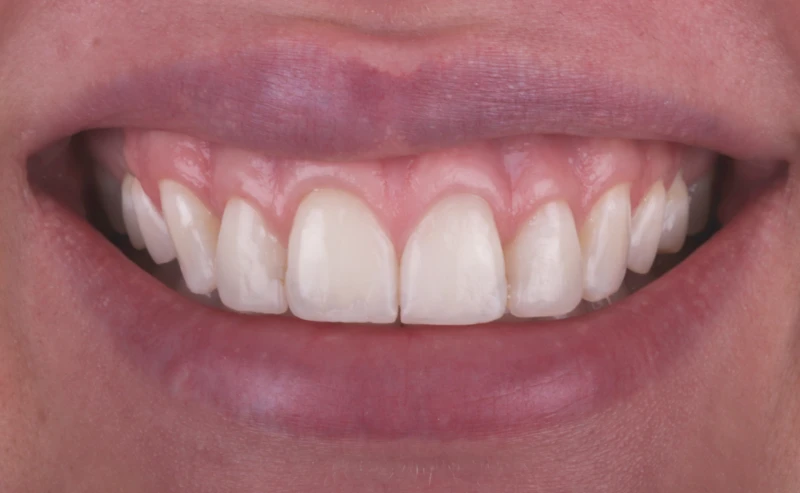 gummy-smile-zahnarzt-krefeld-nachher