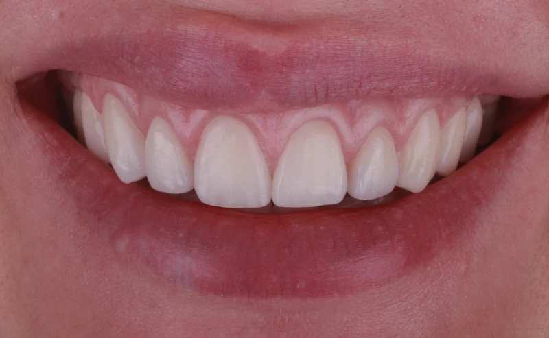 gummy-smile-zahnarzt-krefeld-vorher gummy-smile-zahnarzt-krefeld-vorher