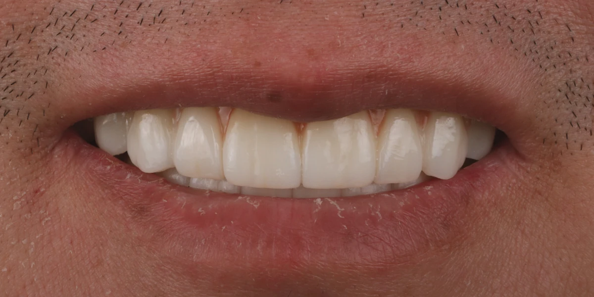 zahnarzt-krefeld-nachher-1