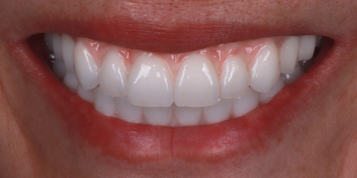 zahnarzt-krefeld-nachher-2