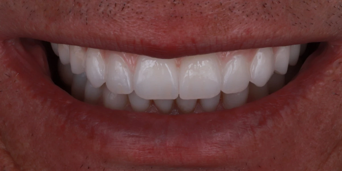 zahnarzt-krefeld-nachher-3