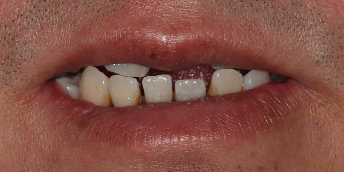 zahnarzt-krefeld-vorher-1