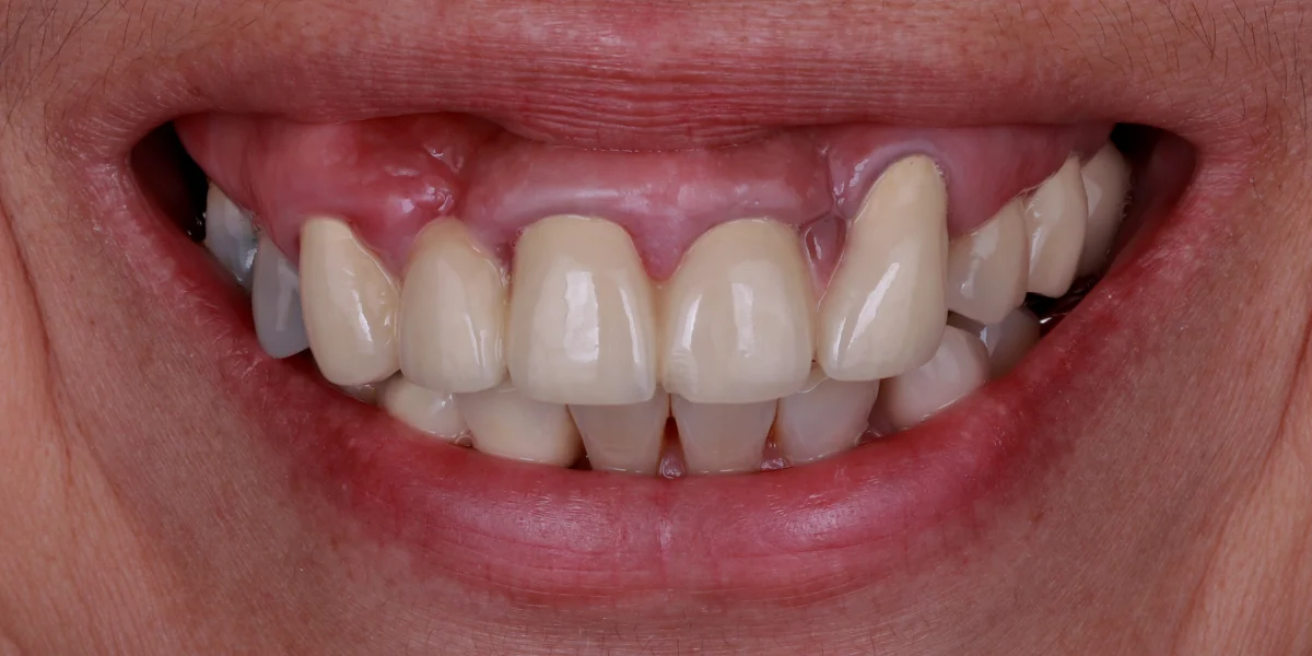 zahnarzt-krefeld-vorher-2