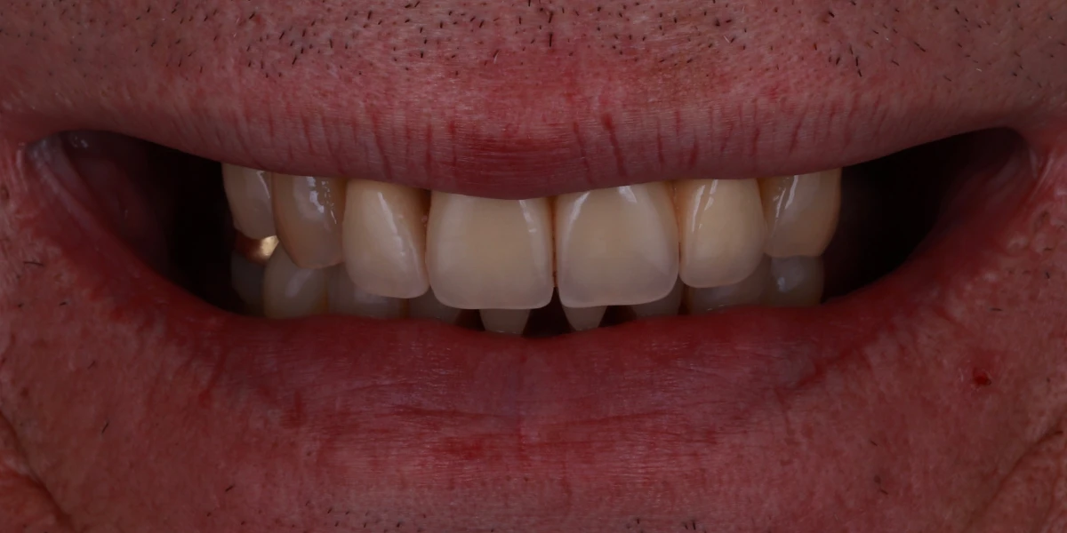 zahnarzt-krefeld-vorher-3