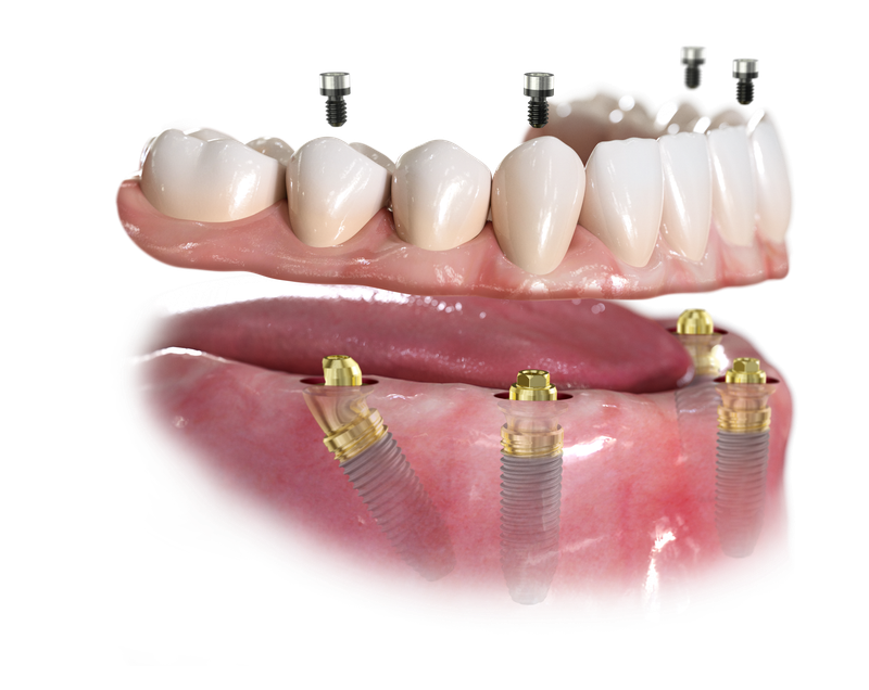 feste zaehne an einen tag zahnarzt krefeld