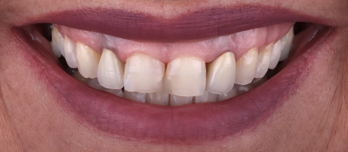 zahnarzt-krefeld-veneers-implantate-vorher