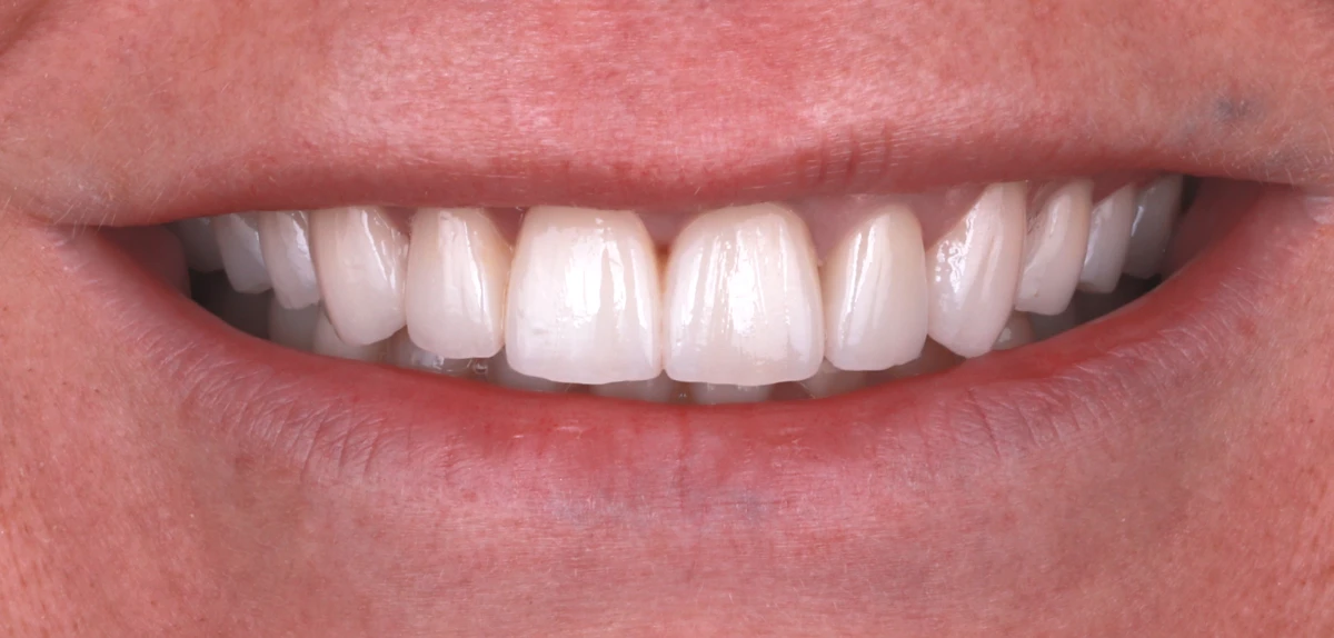 zahnarzt-krefeld-veneers-kronen-nachher