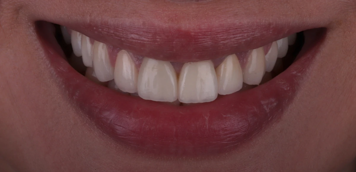 zahnarzt-krefeld-veneers-zahnersatz-nachher